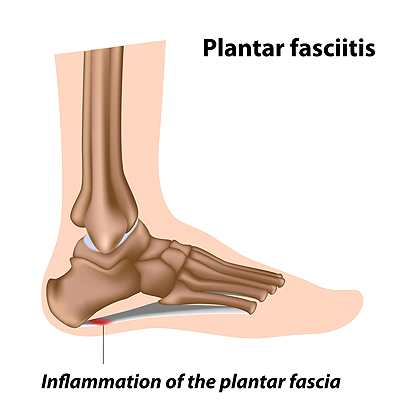 inflammation in the heel of the foot