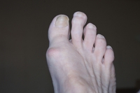 Morton’s Toe Can Cause Pain