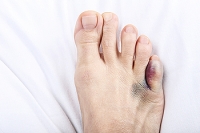 All About Fractures to the Little Toe