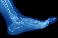 How Do Stress Fractures Affect the Feet?