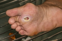 Cuts on the Feet May Be Common in Diabetic Patients