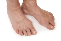 Types of Arthritis That Can Affect Your Feet