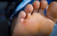 Podiatric Care for Pinky Toe Corns