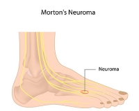 Treatment Options for Morton’s Neuroma